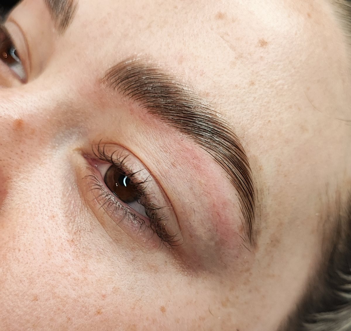 Browlift